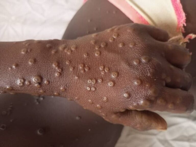 Mpox au Togo : Alerte maîtrisée, vigilance de rigueur.