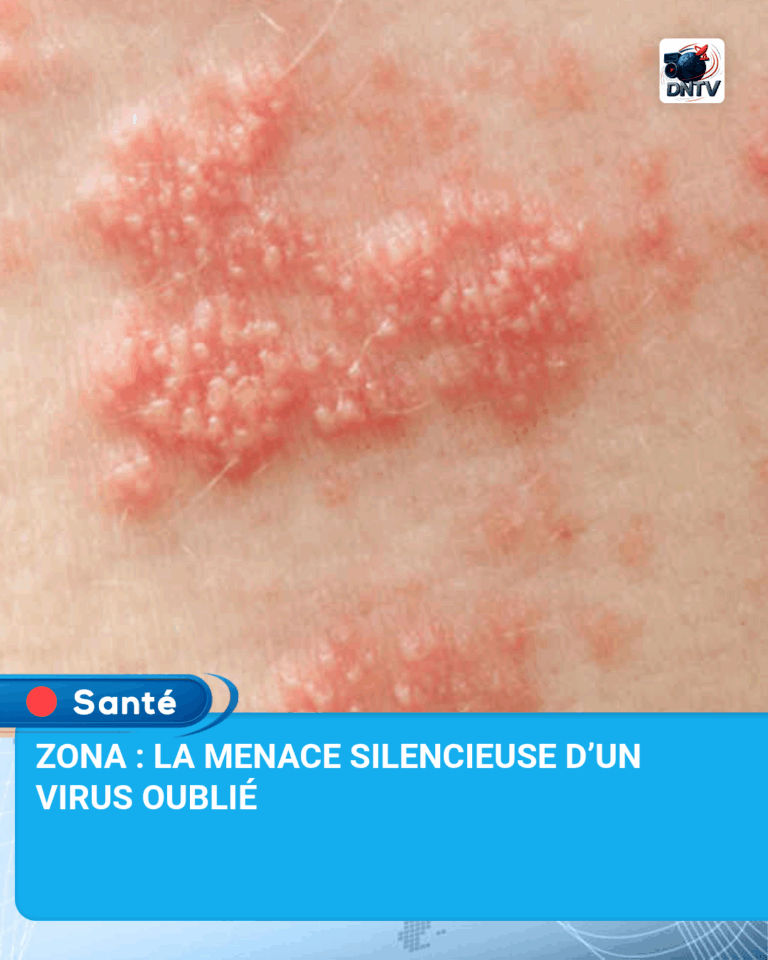 ZONA : LA MENACE SILENCIEUSE D’UN VIRUS OUBLIÉ