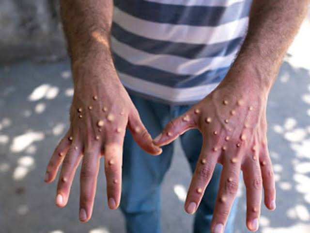 Ghana – Le virus Mpox fait sa première victime : 23 nouveaux cas en une semaine, les autorités renforcent la riposte