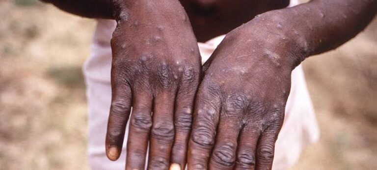 Ghana – Le virus Mpox fait sa première victime : 23 nouveaux cas en une semaine, les autorités renforcent la riposte