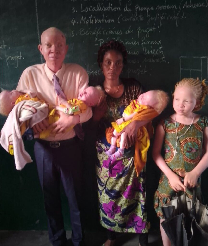 TRISTE NOUVELLE À MBUJI-MAYI : UNE MÈRE REJETÉE POUR AVOIR DONNÉ NAISSANCE À QUATRE ENFANTS ALBINOS
