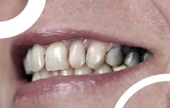 Caries, douleurs dentaires et gencives sensibles : un enjeu mondial de santé publique