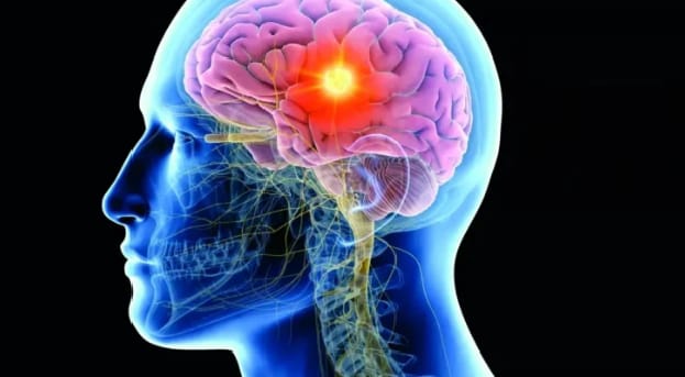 Maladie de Huntington : Une thérapie génique révolutionnaire ralentit la progression de la maladie