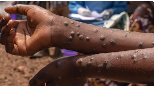 Sénégal : Deux épidémies sous surveillance, la Mpox et la Fièvre de la Vallée du Rift