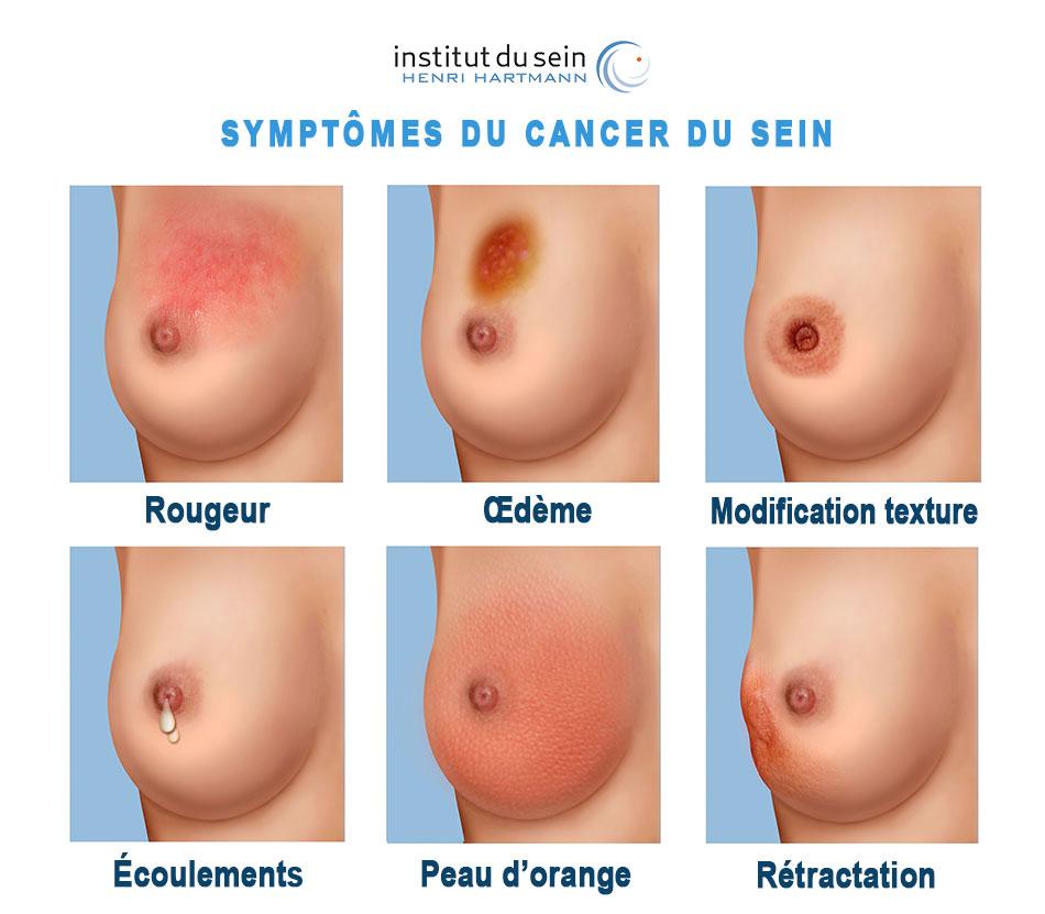 Octobre Rose : Comprendre et prévenir le cancer du sein