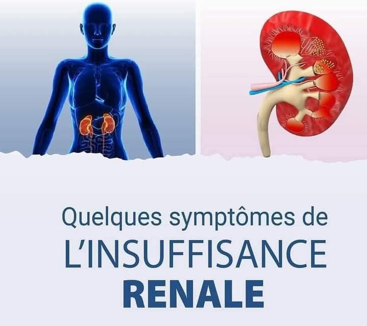 Insuffisance rénale : une maladie silencieuse qui menace des millions de vies