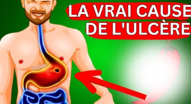 Ulcères d’estomac : 4 aliments naturels essentiels pour favoriser la guérison