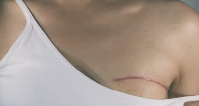 États-Unis : Une avancée chirurgicale révolutionnaire contre le cancer du sein