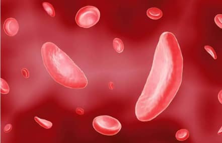 Drépanocytose au Sénégal : comprendre la maladie, les avancées médicales et les réalités vécues par les patients