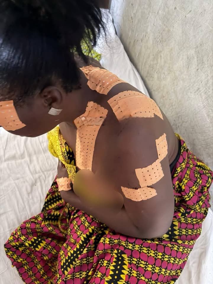 Cameroun : une femme grièvement blessée après une violente agression conjugale dans le Centre
