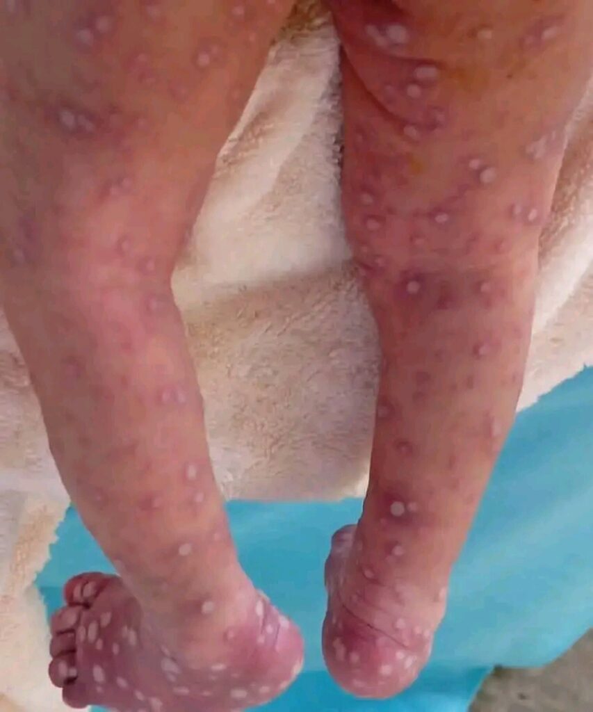 Cameroun : Un nourrisson de 14 jours emporté par le Mpox à Douala, les autorités sanitaires renforcent la riposte.