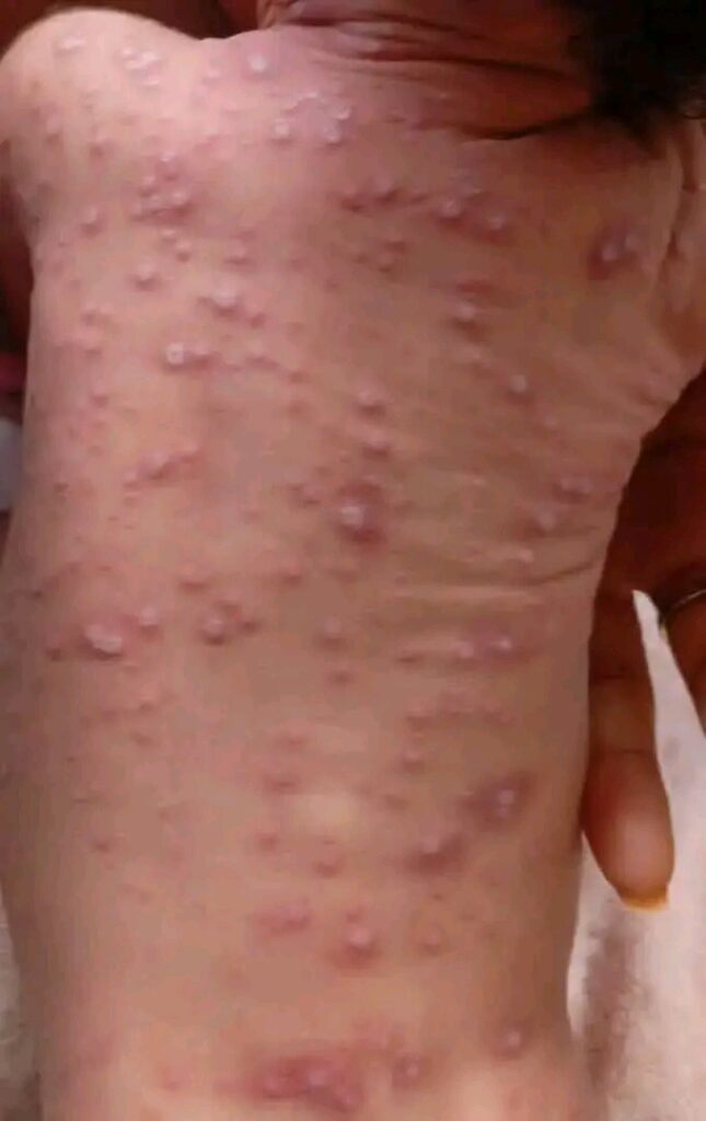 Cameroun : Un nourrisson de 14 jours emporté par le Mpox à Douala, les autorités sanitaires renforcent la riposte.